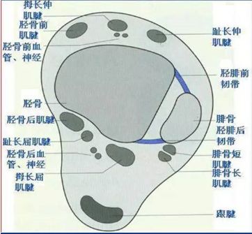 影像PPT - 踝关节MRI解剖及7种常见损伤类型影像表现-18 影像PPT - 踝关节MRI解剖及7种常见损伤类型影像表现-18