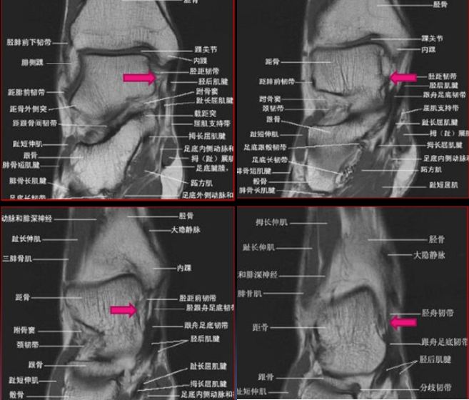 影像PPT - 踝关节MRI解剖及7种常见损伤类型影像表现-25 影像PPT - 踝关节MRI解剖及7种常见损伤类型影像表现-25