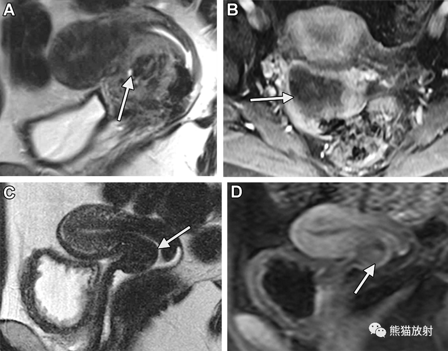 影像PPT - 骨外尤文氏肉瘤发病部位及影像表现-13 影像PPT - 骨外尤文氏肉瘤发病部位及影像表现-13