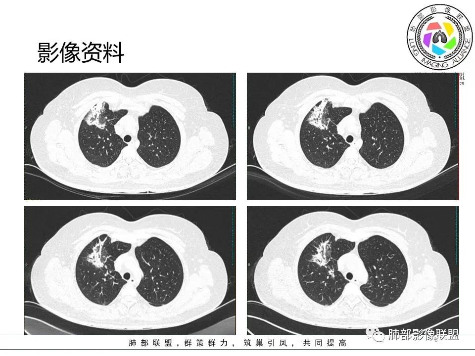 影像PPT - 【病例】隐源性机化性肺炎1例-8 影像PPT - 【病例】隐源性机化性肺炎1例-8