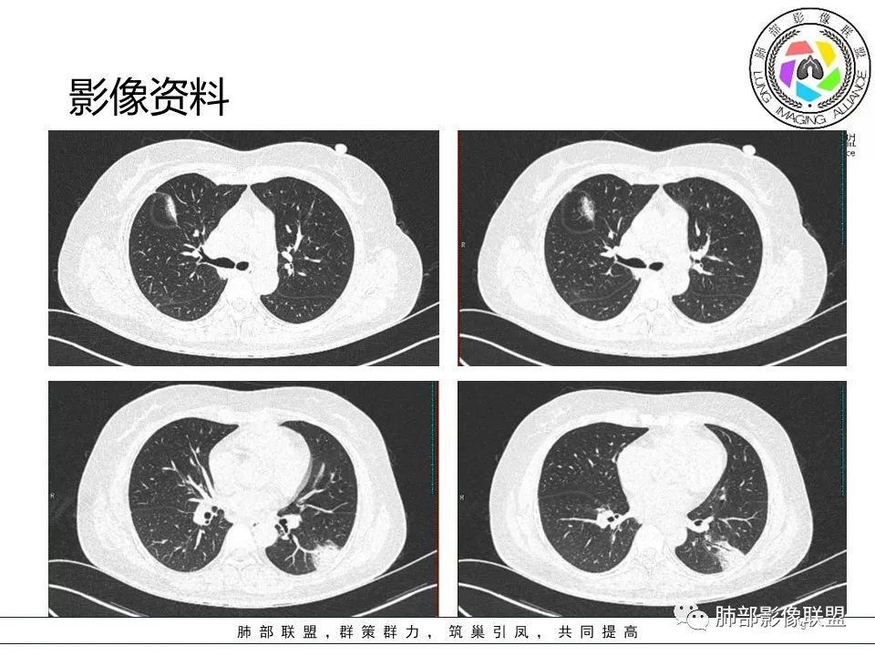 影像PPT - 【病例】隐源性机化性肺炎1例-9 影像PPT - 【病例】隐源性机化性肺炎1例-9