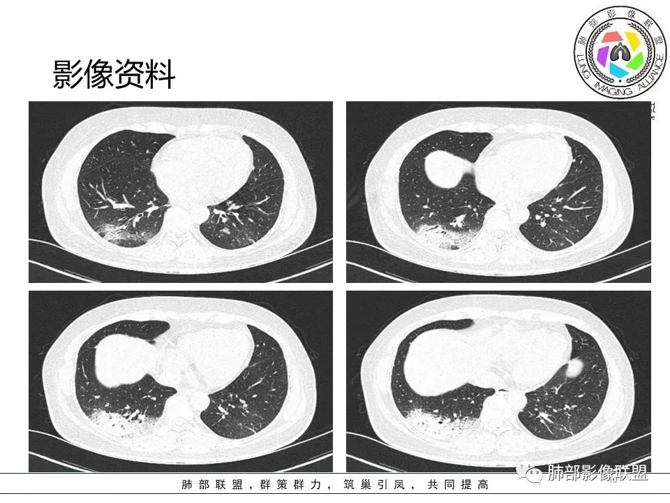 影像PPT - 【病例】隐源性机化性肺炎1例-10 影像PPT - 【病例】隐源性机化性肺炎1例-10