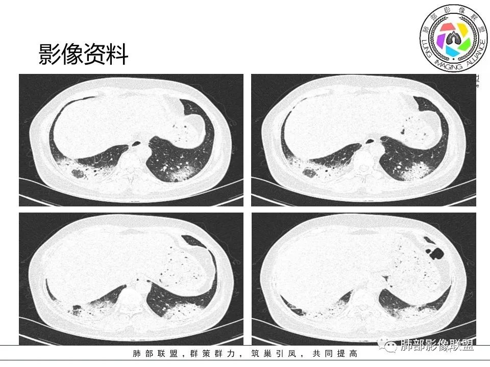 影像PPT - 【病例】隐源性机化性肺炎1例-11 影像PPT - 【病例】隐源性机化性肺炎1例-11