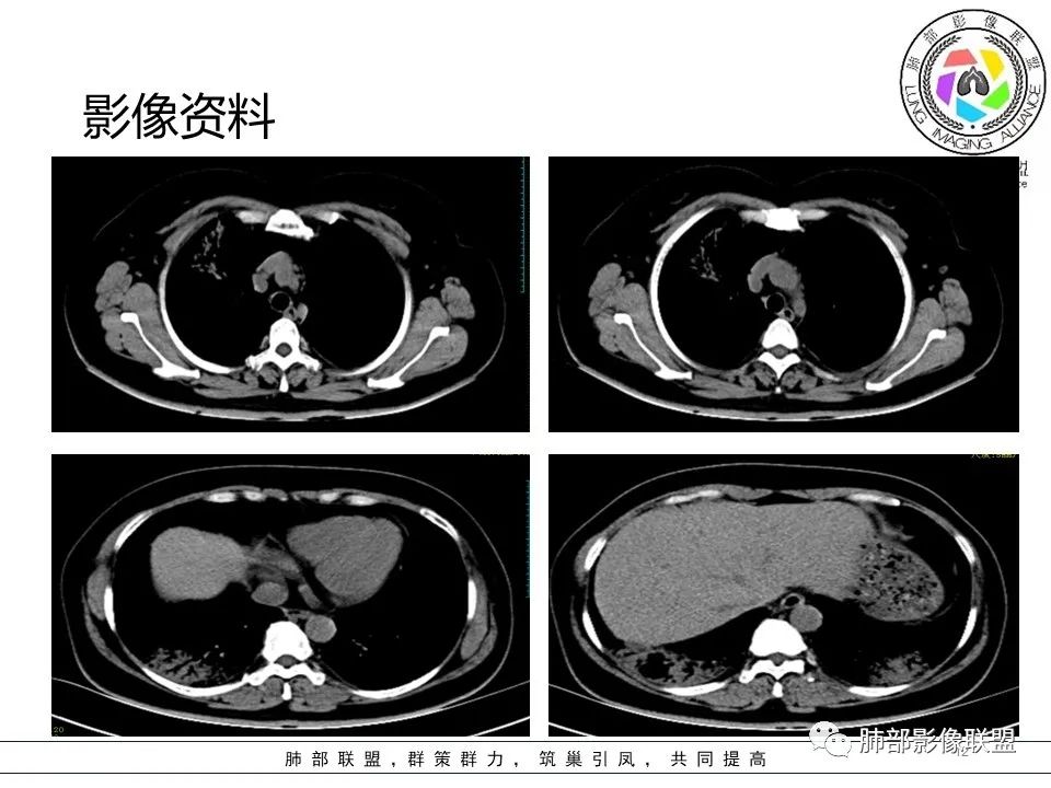影像PPT - 【病例】隐源性机化性肺炎1例-12 影像PPT - 【病例】隐源性机化性肺炎1例-12