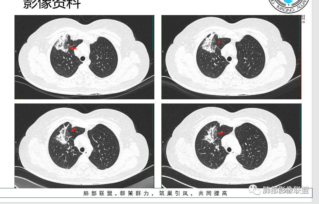 影像PPT - 【病例】隐源性机化性肺炎1例-17 影像PPT - 【病例】隐源性机化性肺炎1例-17