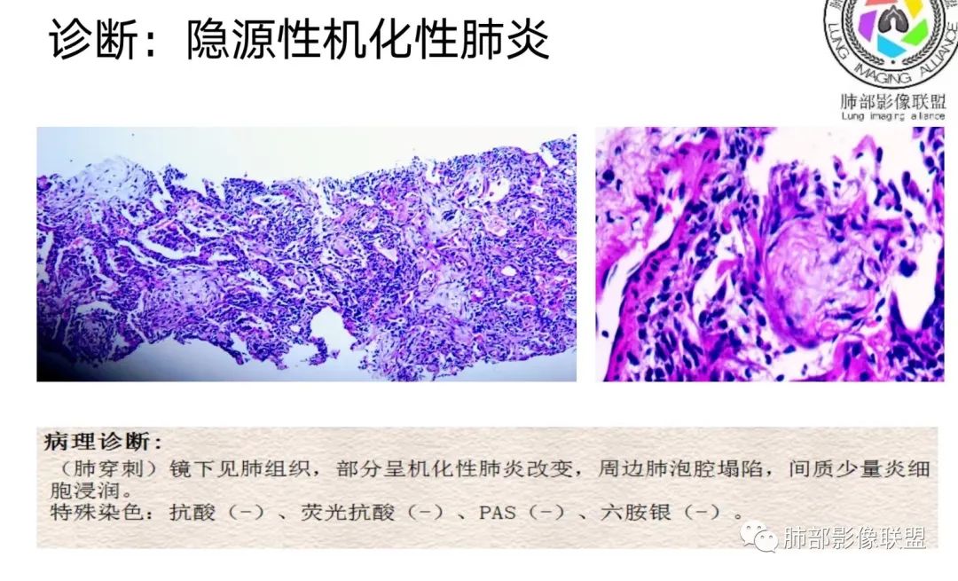 影像PPT - 【病例】隐源性机化性肺炎1例-21 影像PPT - 【病例】隐源性机化性肺炎1例-21