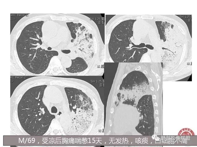影像PPT - 【病例】隐源性机化性肺炎1例-32