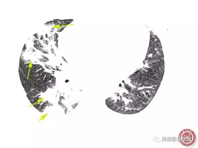 影像PPT - 【病例】隐源性机化性肺炎1例-36 影像PPT - 【病例】隐源性机化性肺炎1例-36