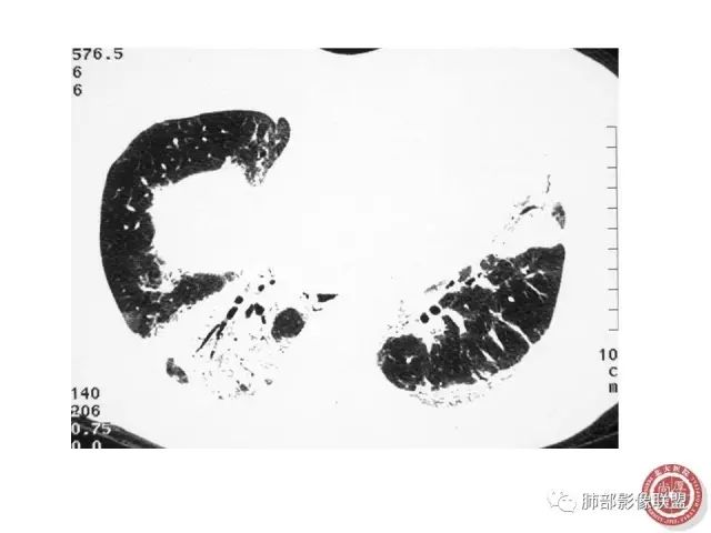 影像PPT - 【病例】隐源性机化性肺炎1例-37 影像PPT - 【病例】隐源性机化性肺炎1例-37