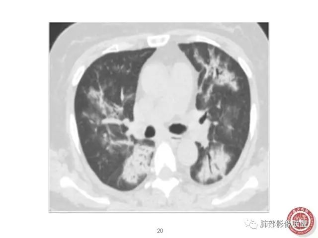 影像PPT - 【病例】隐源性机化性肺炎1例-39 影像PPT - 【病例】隐源性机化性肺炎1例-39