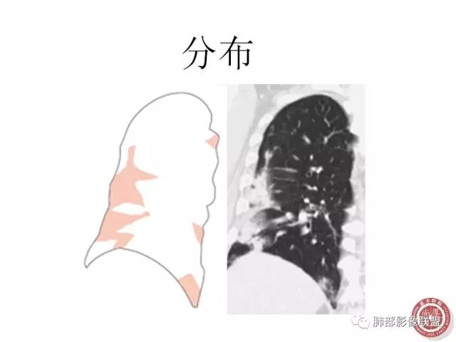 影像PPT - 【病例】隐源性机化性肺炎1例-40 影像PPT - 【病例】隐源性机化性肺炎1例-40