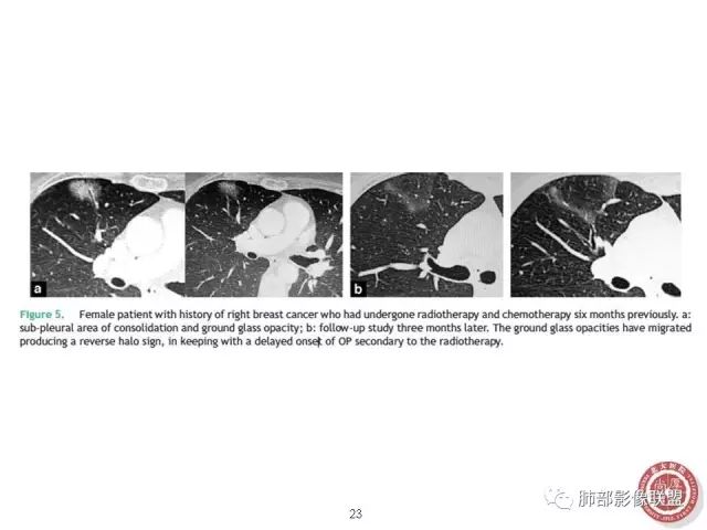 影像PPT - 【病例】隐源性机化性肺炎1例-42 影像PPT - 【病例】隐源性机化性肺炎1例-42