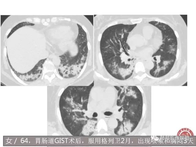 影像PPT - 【病例】隐源性机化性肺炎1例-43 影像PPT - 【病例】隐源性机化性肺炎1例-43