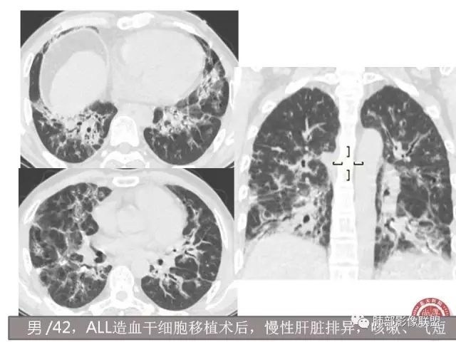 影像PPT - 【病例】隐源性机化性肺炎1例-44 影像PPT - 【病例】隐源性机化性肺炎1例-44