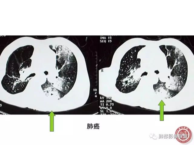 影像PPT - 【病例】隐源性机化性肺炎1例-45
