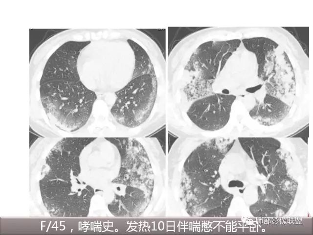 影像PPT - 【病例】隐源性机化性肺炎1例-47
