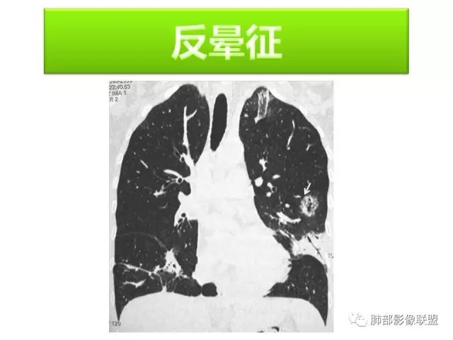 影像PPT - 【病例】隐源性机化性肺炎1例-50
