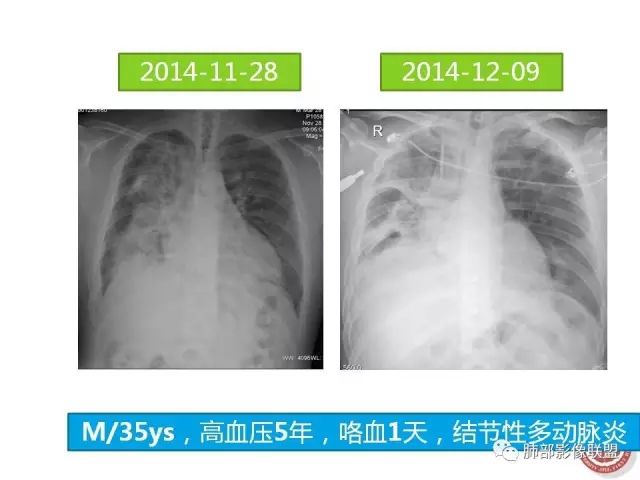 影像PPT - 【病例】隐源性机化性肺炎1例-52 影像PPT - 【病例】隐源性机化性肺炎1例-52