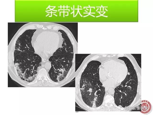 影像PPT - 【病例】隐源性机化性肺炎1例-55 影像PPT - 【病例】隐源性机化性肺炎1例-55