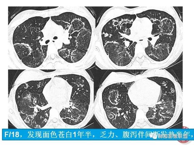 影像PPT - 【病例】隐源性机化性肺炎1例-54