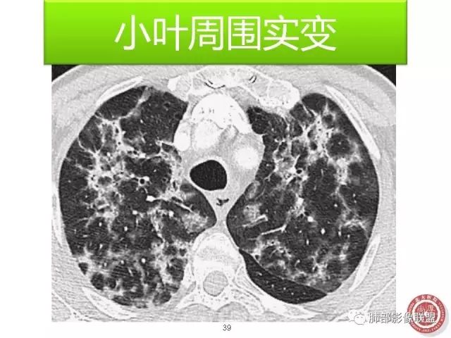 影像PPT - 【病例】隐源性机化性肺炎1例-56 影像PPT - 【病例】隐源性机化性肺炎1例-56