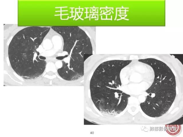 影像PPT - 【病例】隐源性机化性肺炎1例-57 影像PPT - 【病例】隐源性机化性肺炎1例-57