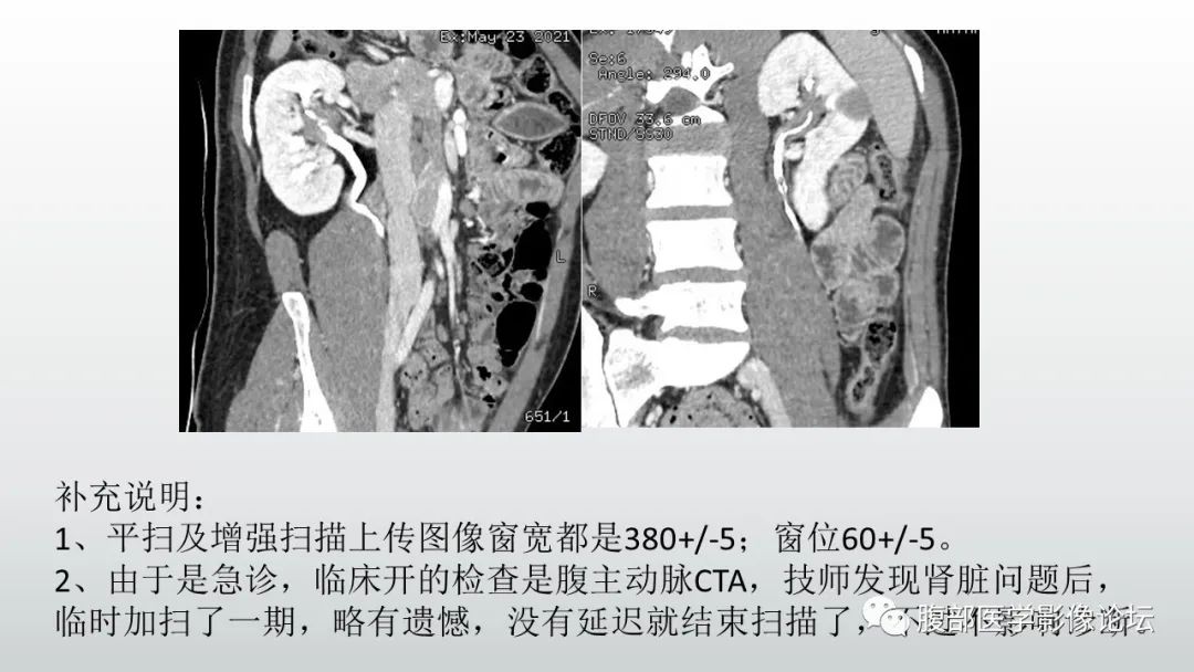 影像PPT - 【病例】急性淋巴细胞白血病累及肾脏1例CT影像表现-22