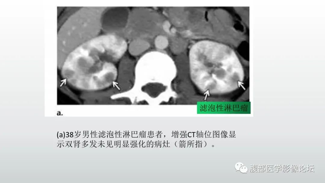 影像PPT - 【病例】急性淋巴细胞白血病累及肾脏1例CT影像表现-26