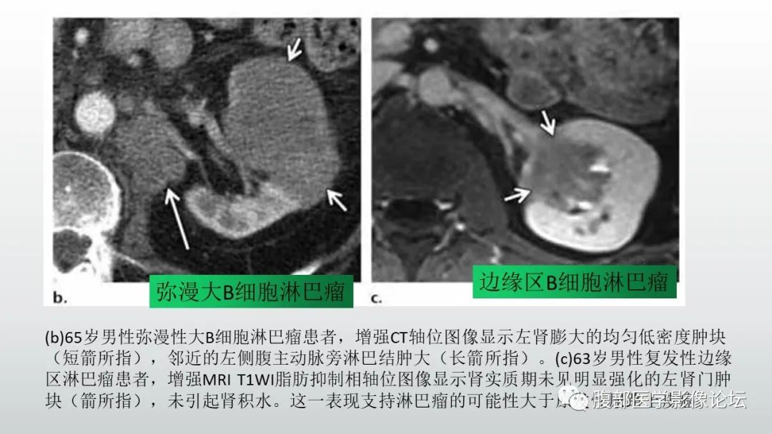 影像PPT - 【病例】急性淋巴细胞白血病累及肾脏1例CT影像表现-27