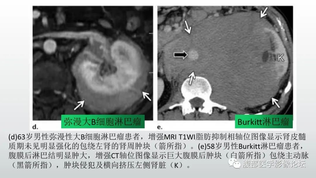 影像PPT - 【病例】急性淋巴细胞白血病累及肾脏1例CT影像表现-28