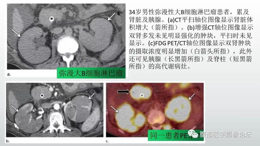 影像PPT - 【病例】急性淋巴细胞白血病累及肾脏1例CT影像表现-29