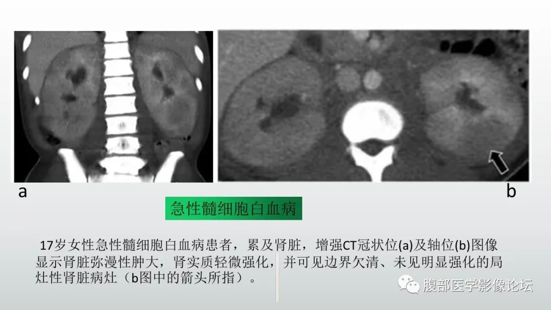 影像PPT - 【病例】急性淋巴细胞白血病累及肾脏1例CT影像表现-31
