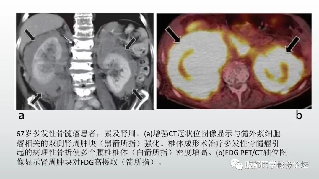 影像PPT - 【病例】急性淋巴细胞白血病累及肾脏1例CT影像表现-33