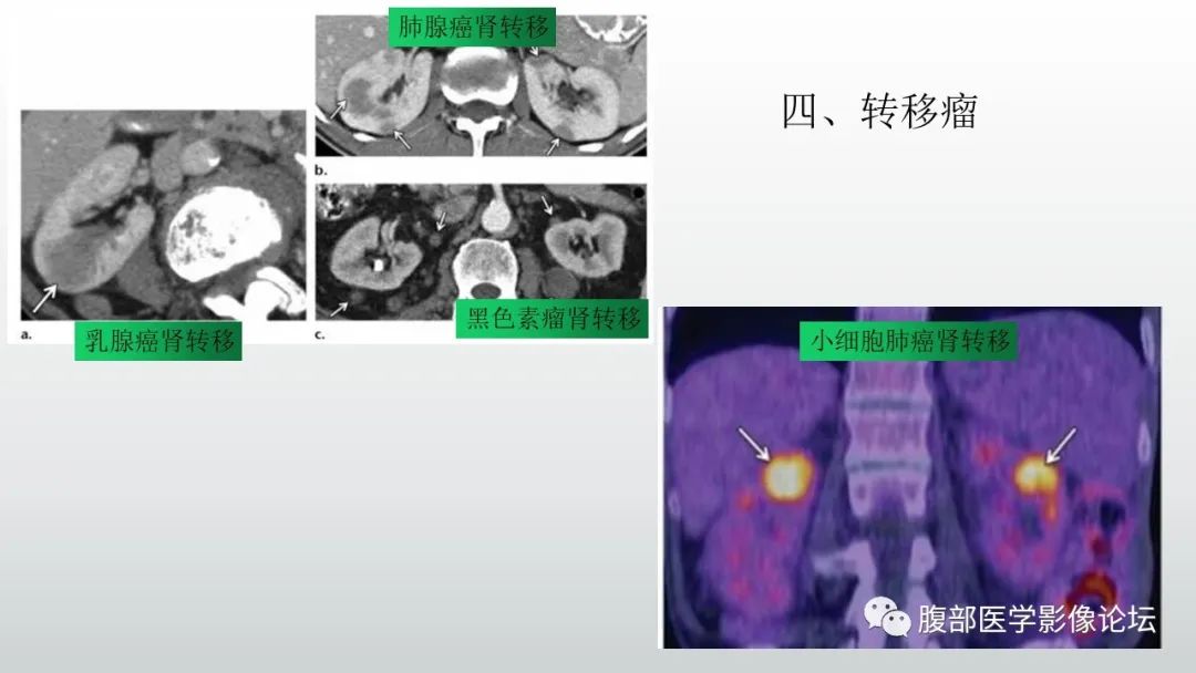 影像PPT - 【病例】急性淋巴细胞白血病累及肾脏1例CT影像表现-34