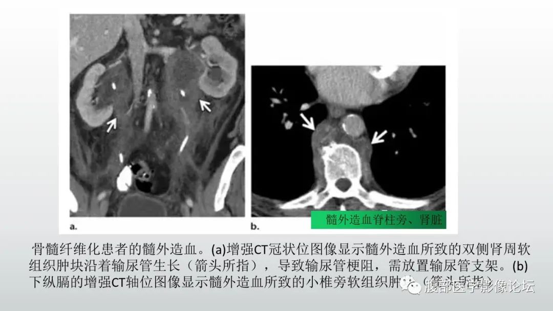 影像PPT - 【病例】急性淋巴细胞白血病累及肾脏1例CT影像表现-36