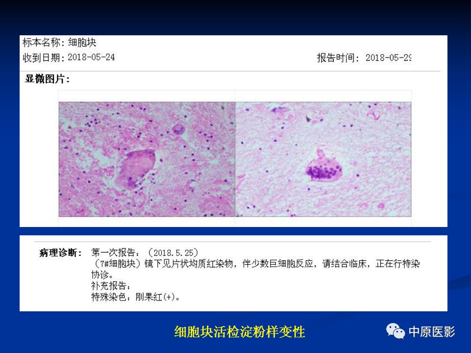 影像PPT - 【PPT】淀粉样变性心肌病的MRI表现-12