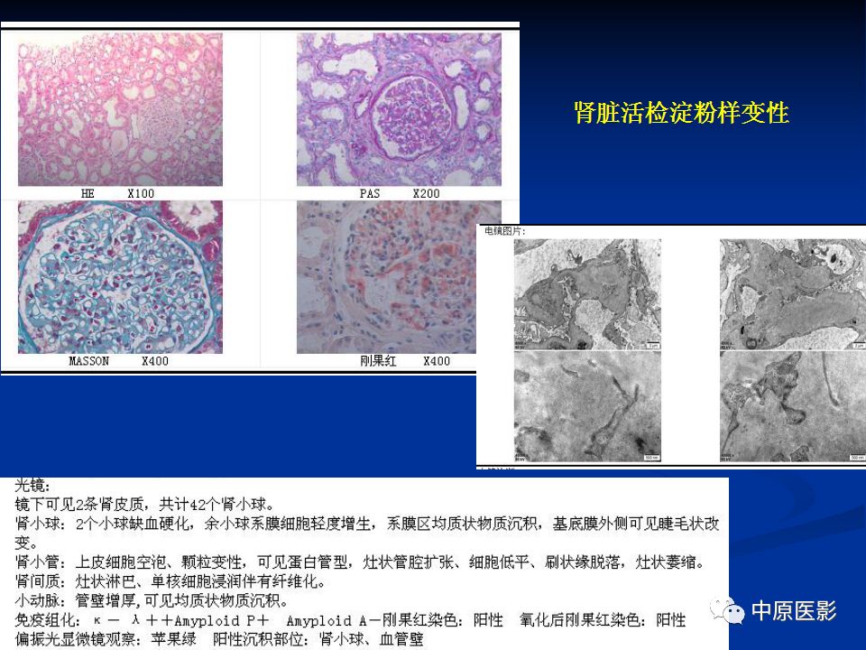 影像PPT - 【PPT】淀粉样变性心肌病的MRI表现-13