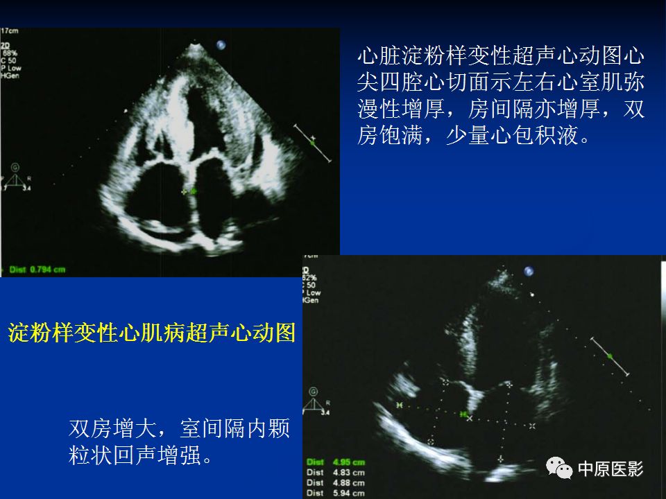 影像PPT - 【PPT】淀粉样变性心肌病的MRI表现-16