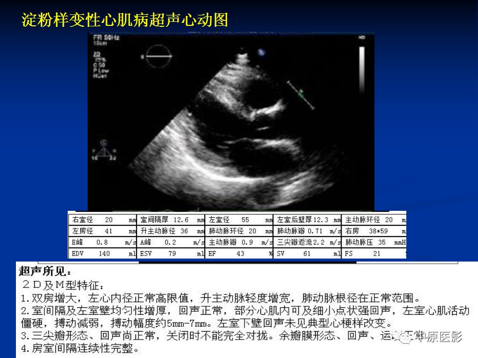 影像PPT - 【PPT】淀粉样变性心肌病的MRI表现-15