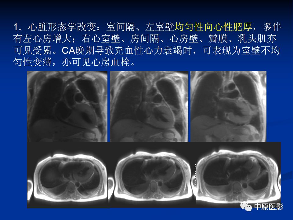 影像PPT - 【PPT】淀粉样变性心肌病的MRI表现-19
