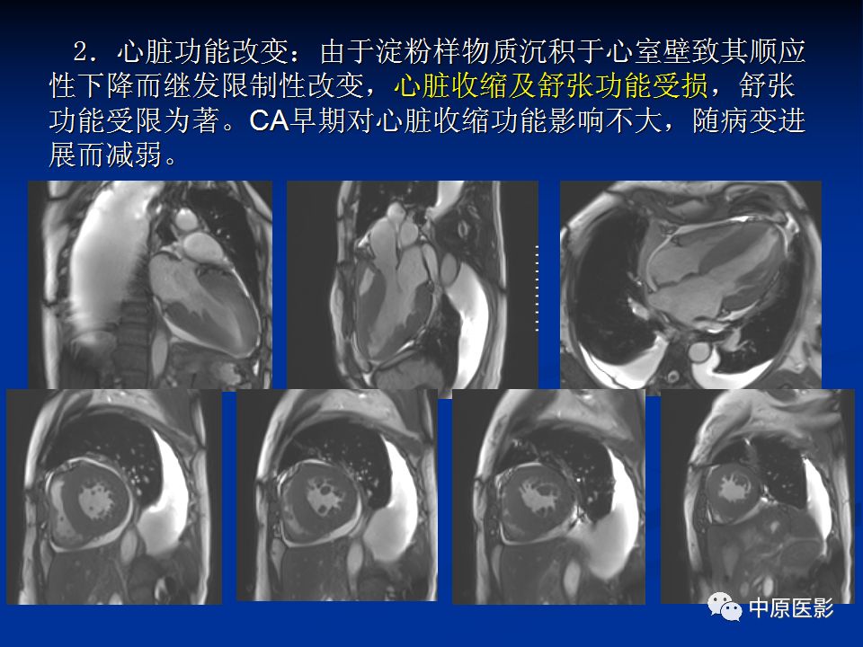 影像PPT - 【PPT】淀粉样变性心肌病的MRI表现-20