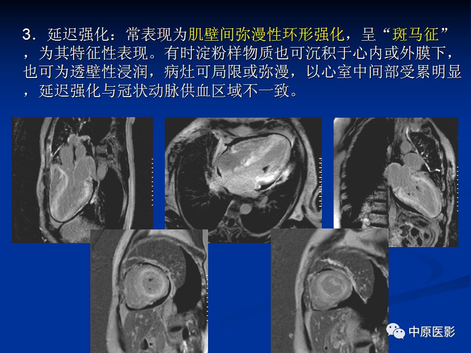 影像PPT - 【PPT】淀粉样变性心肌病的MRI表现-21