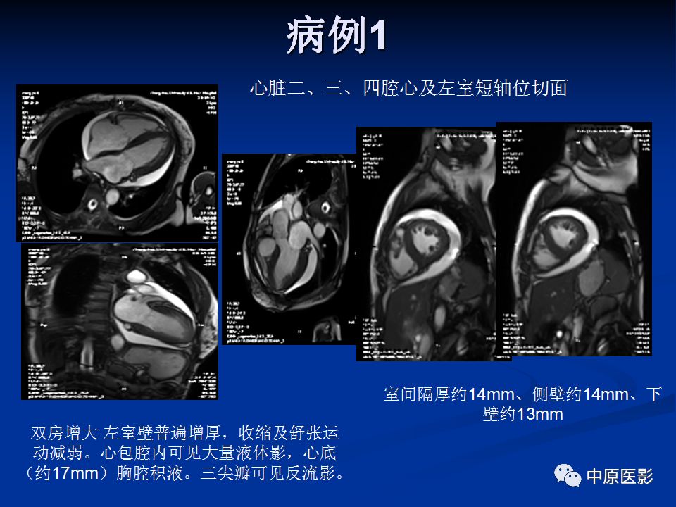 影像PPT - 【PPT】淀粉样变性心肌病的MRI表现-24