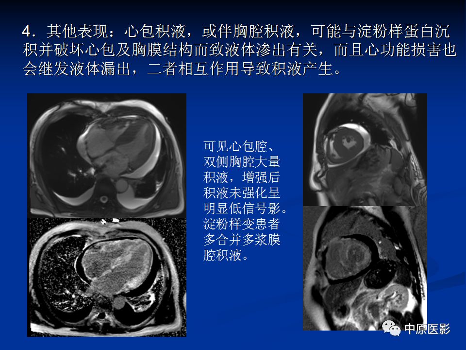 影像PPT - 【PPT】淀粉样变性心肌病的MRI表现-23