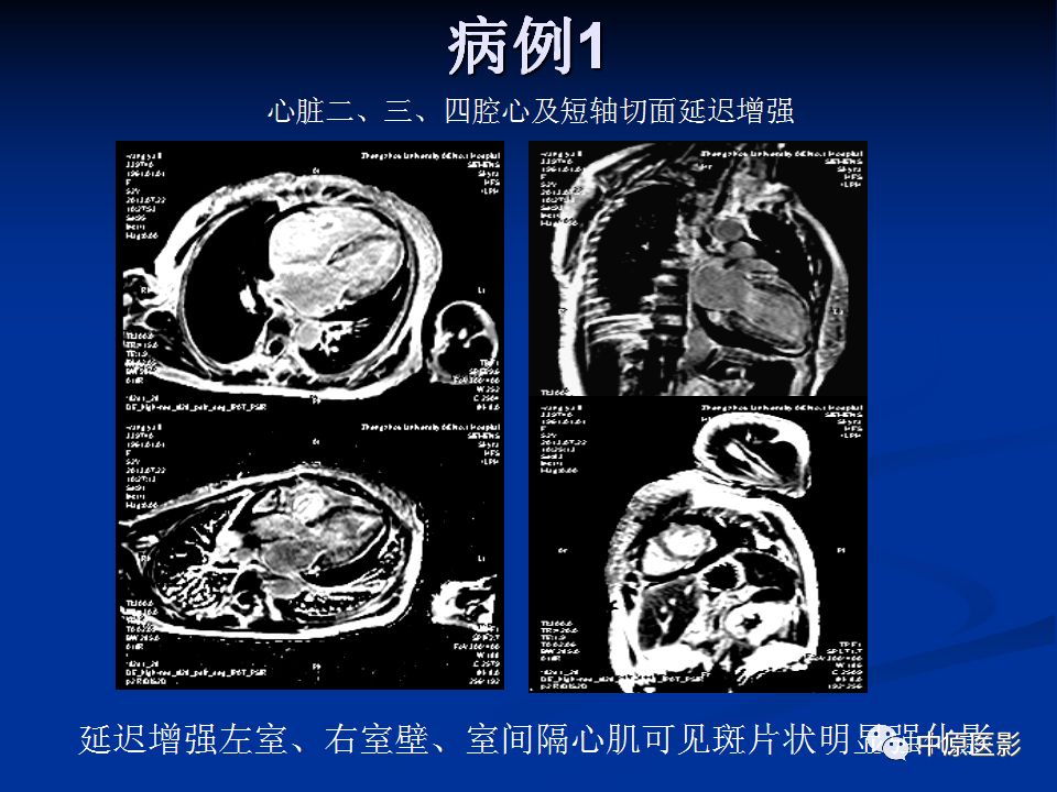 影像PPT - 【PPT】淀粉样变性心肌病的MRI表现-25