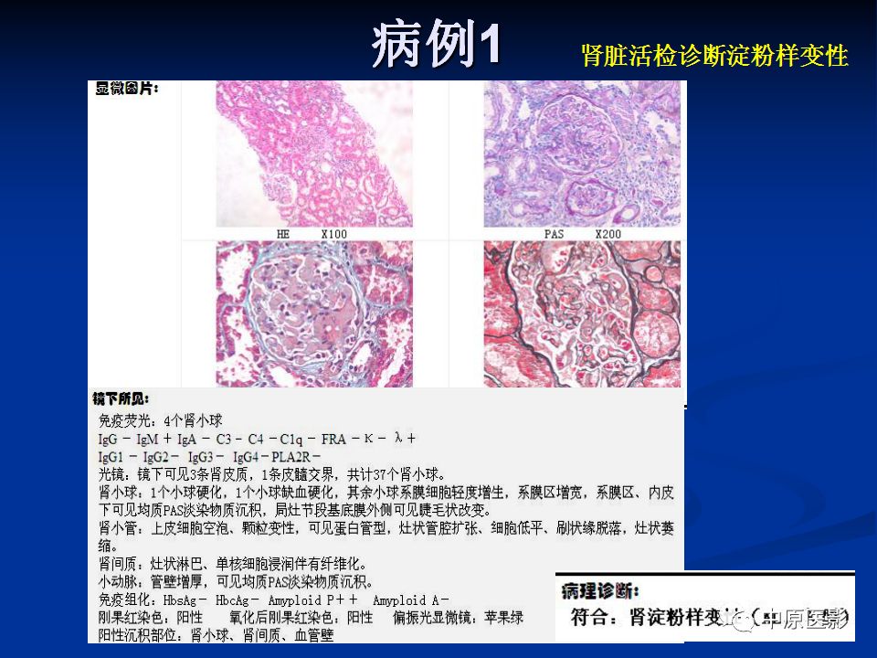 影像PPT - 【PPT】淀粉样变性心肌病的MRI表现-26
