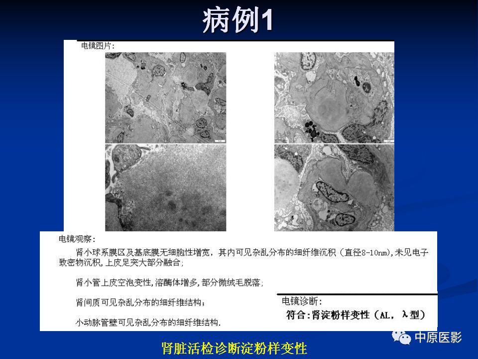影像PPT - 【PPT】淀粉样变性心肌病的MRI表现-27