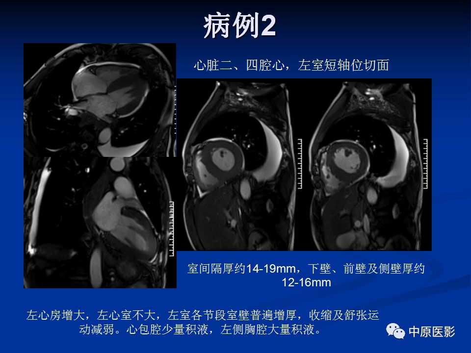 影像PPT - 【PPT】淀粉样变性心肌病的MRI表现-28