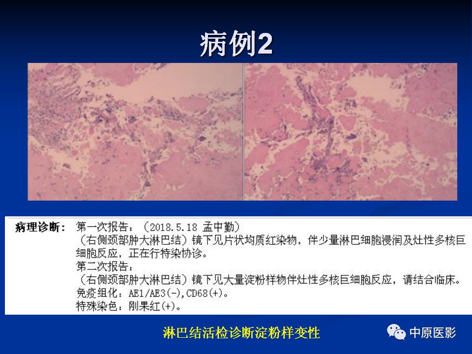 影像PPT - 【PPT】淀粉样变性心肌病的MRI表现-30