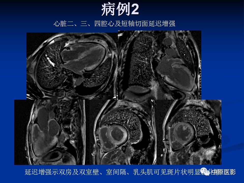影像PPT - 【PPT】淀粉样变性心肌病的MRI表现-29